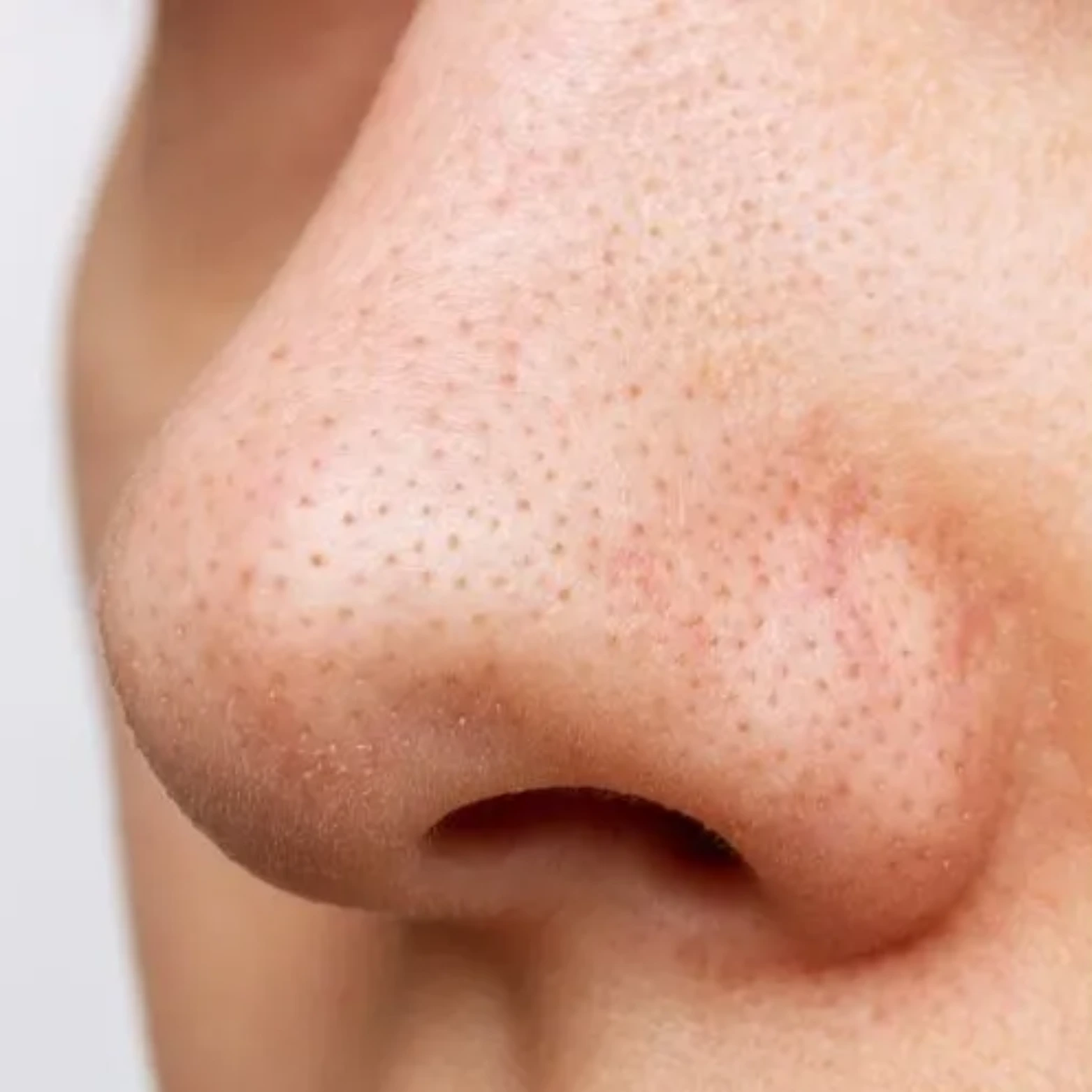 Blackheads Removal Clinic