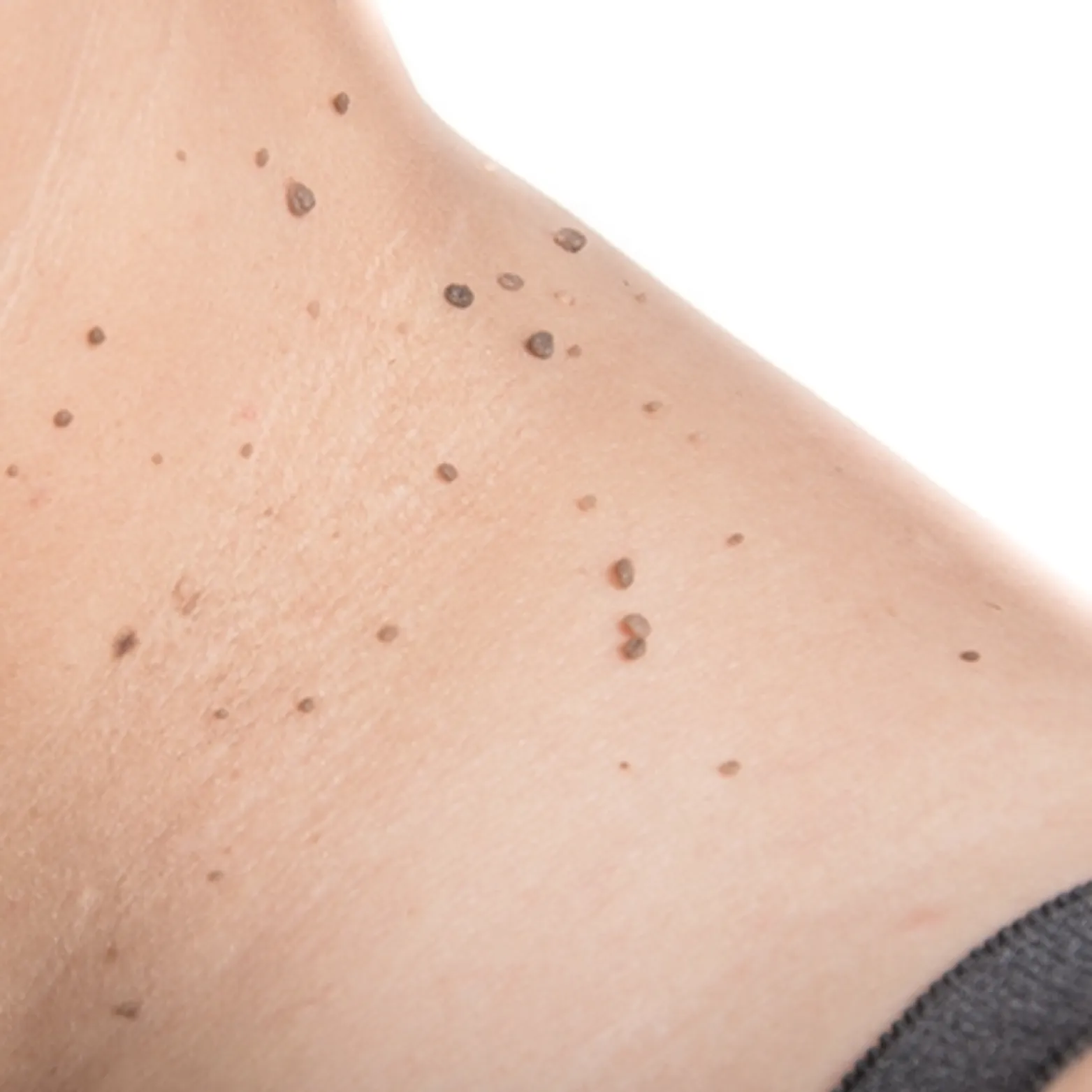 Skin Tags