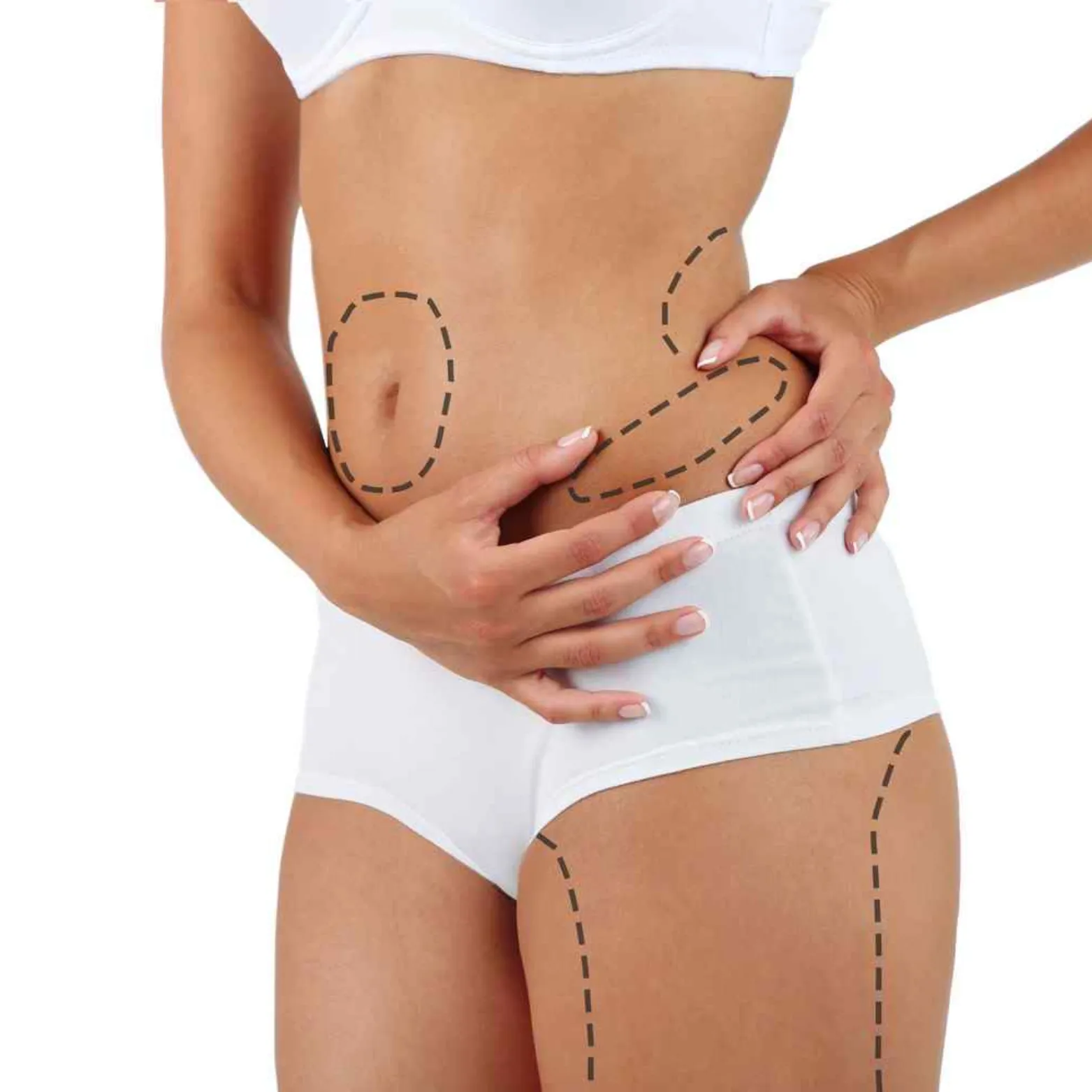 CoolSculpting