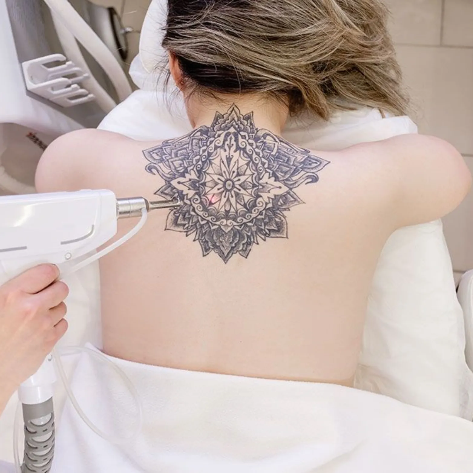 Laser Tattoo Removal