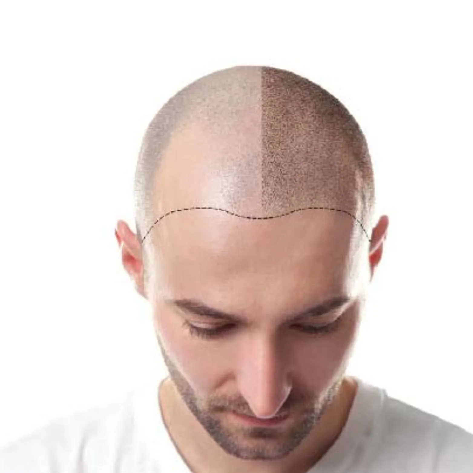 Hair Transplant