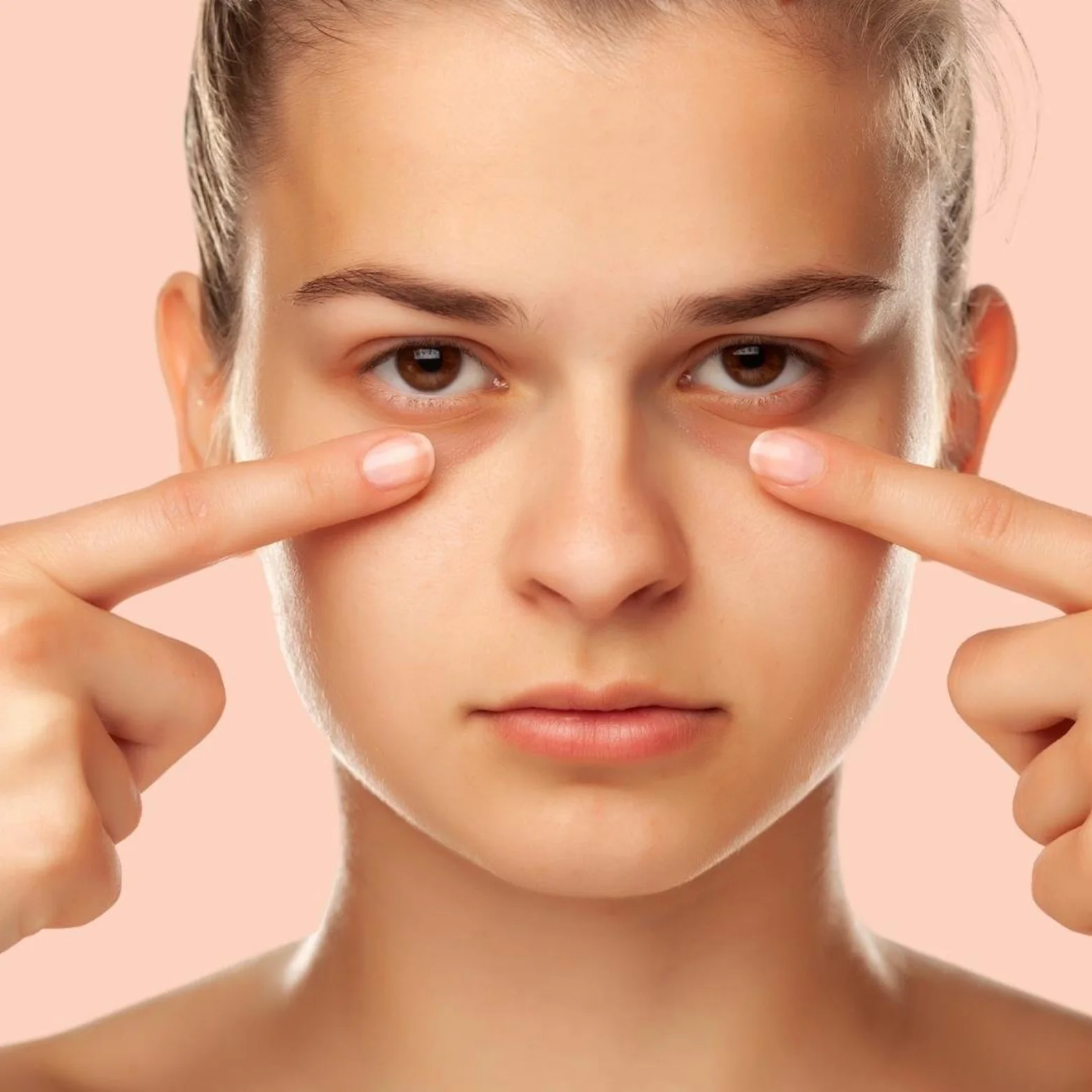 Dark Circles (Under Eye)