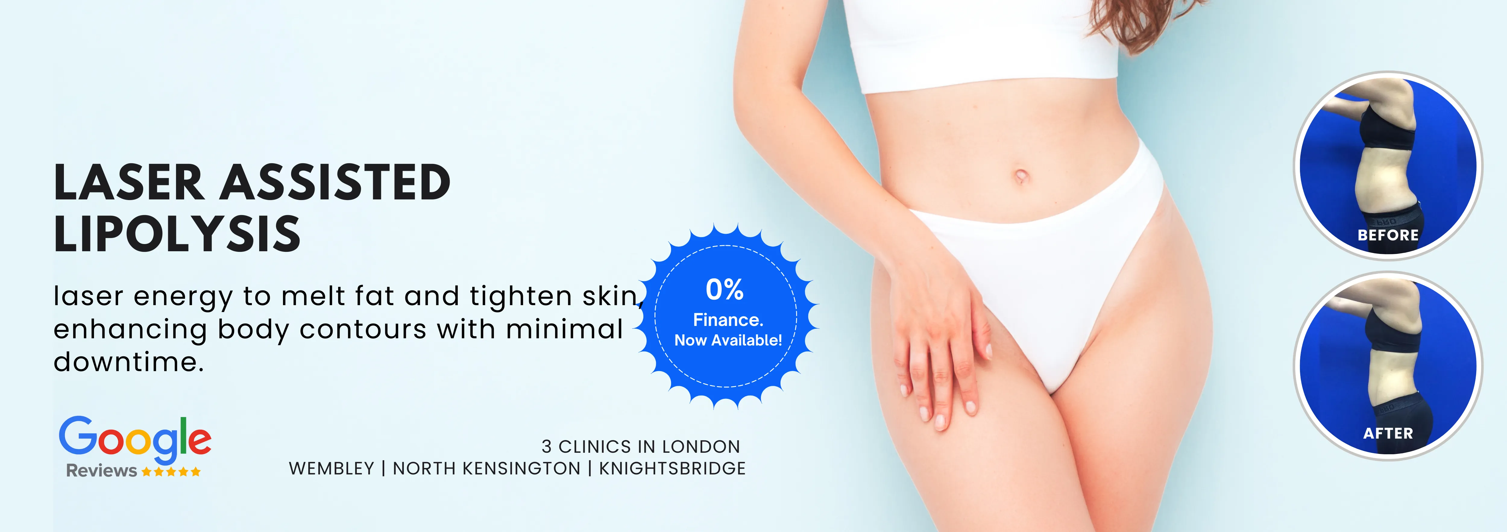 Laser Assisted Lipolysis