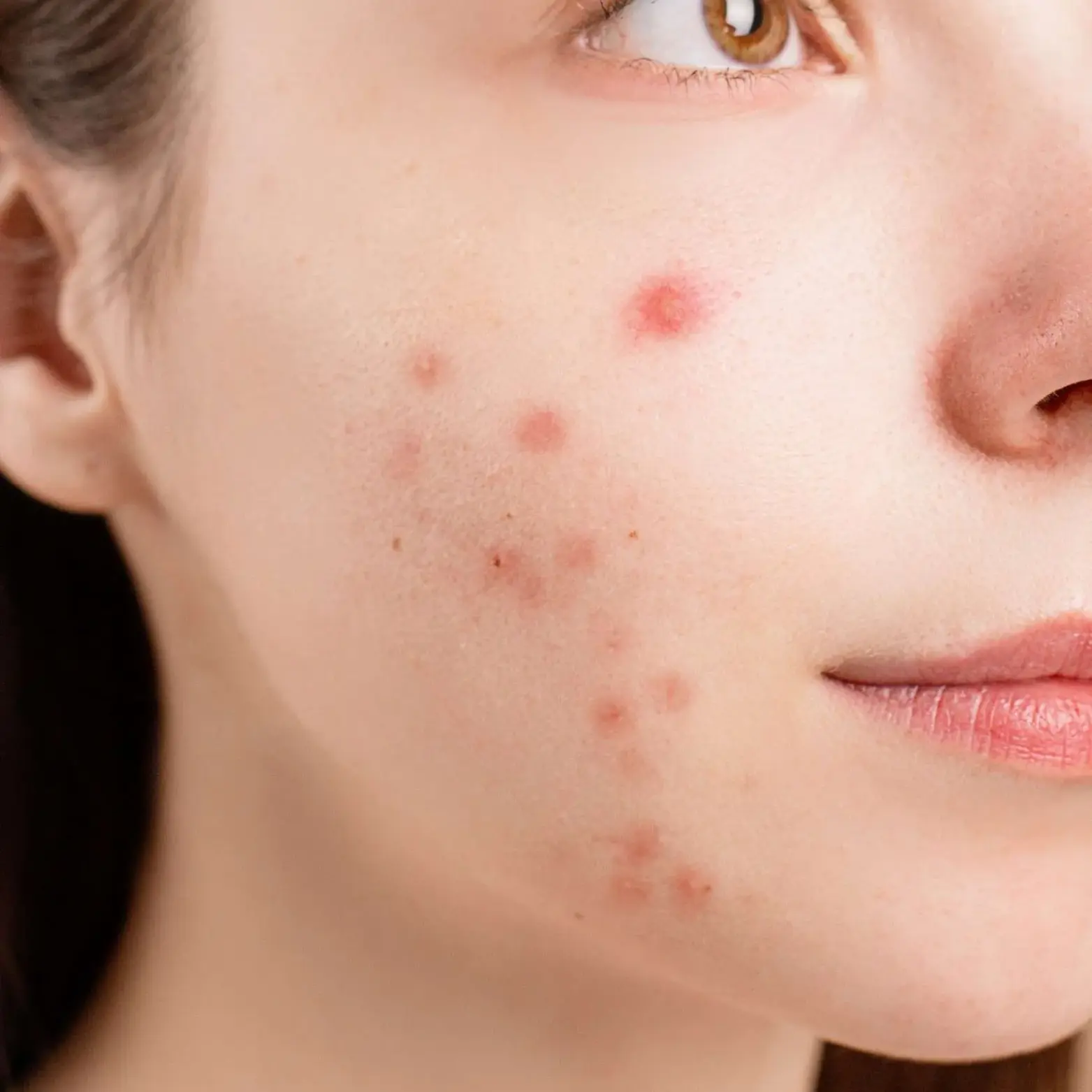 Acne Vulgaris