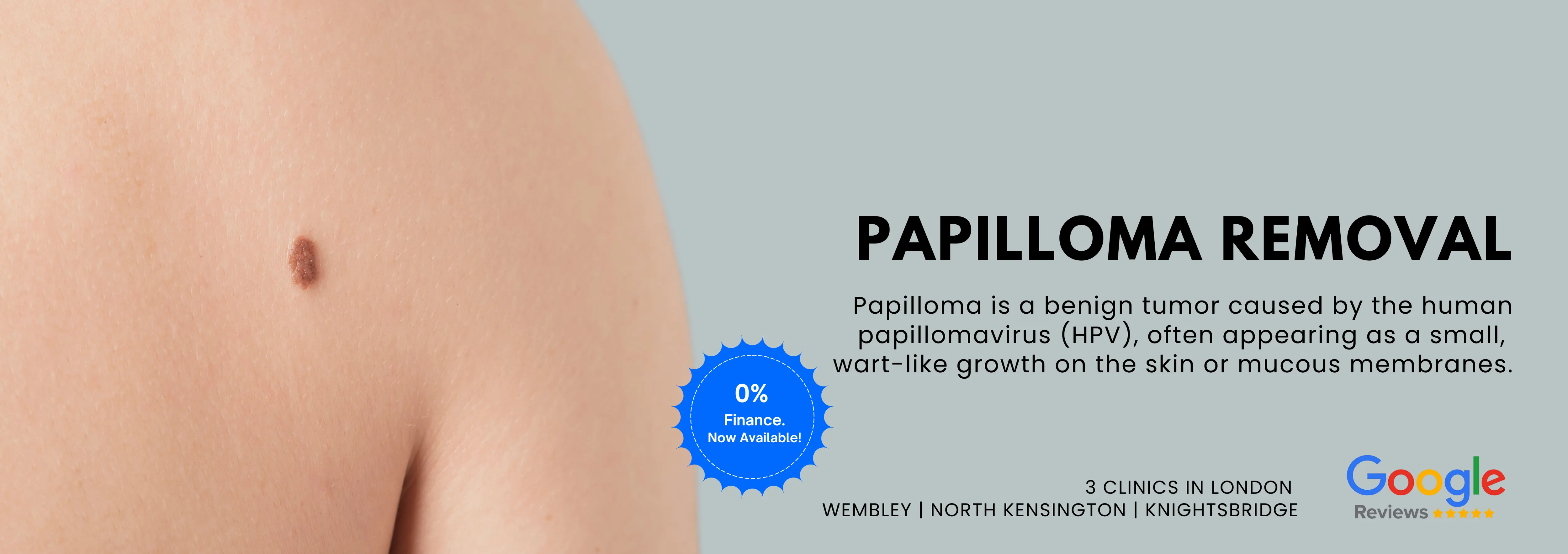 Papilloma Removal
