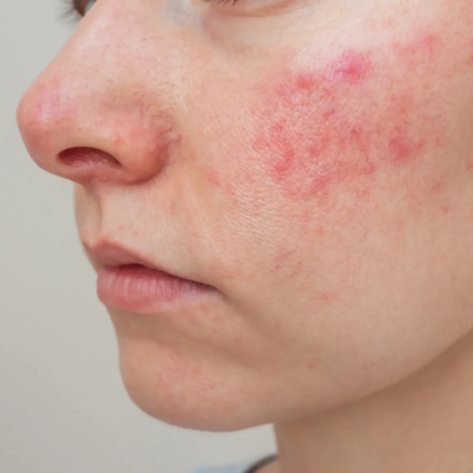 Rosacea