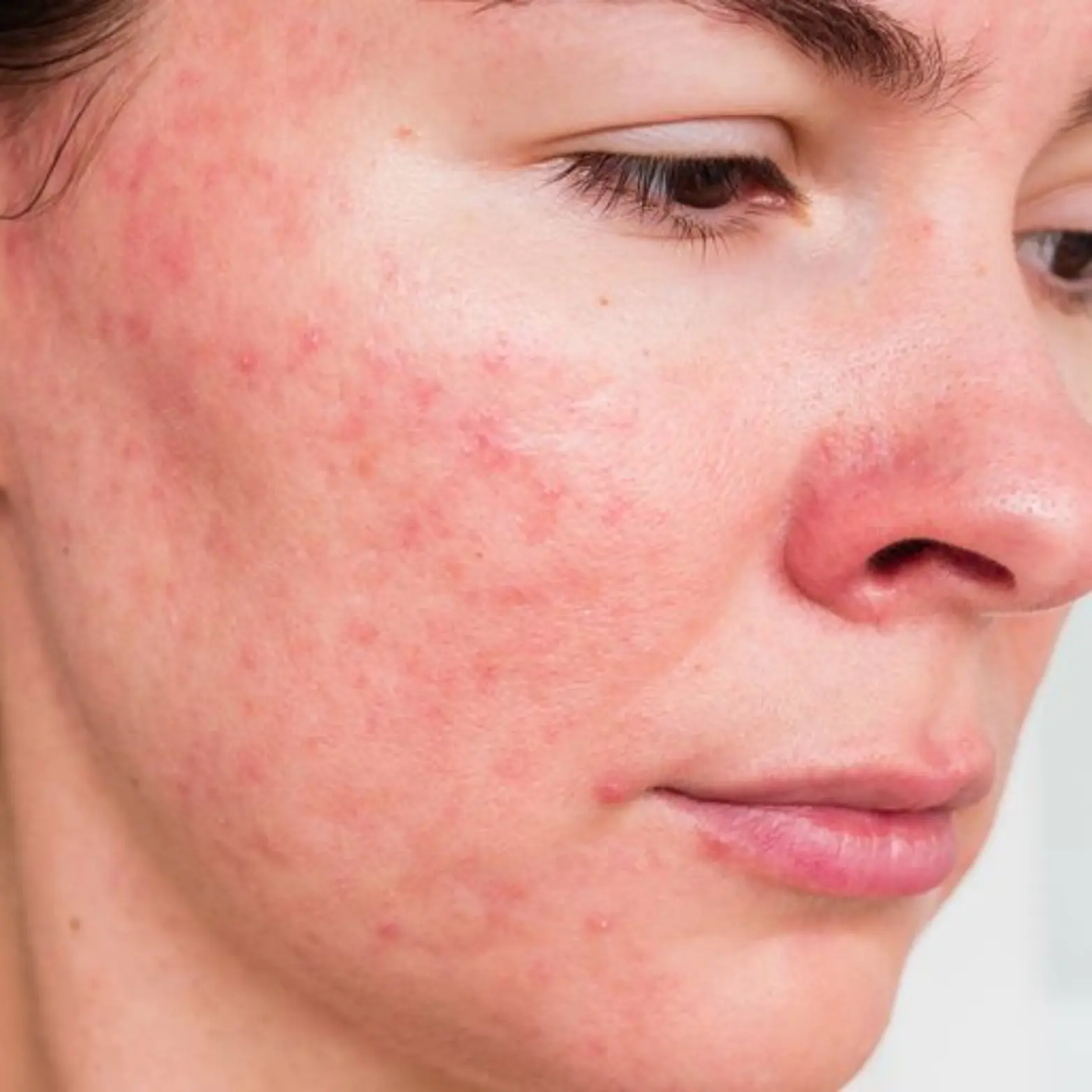 Acne Scarring