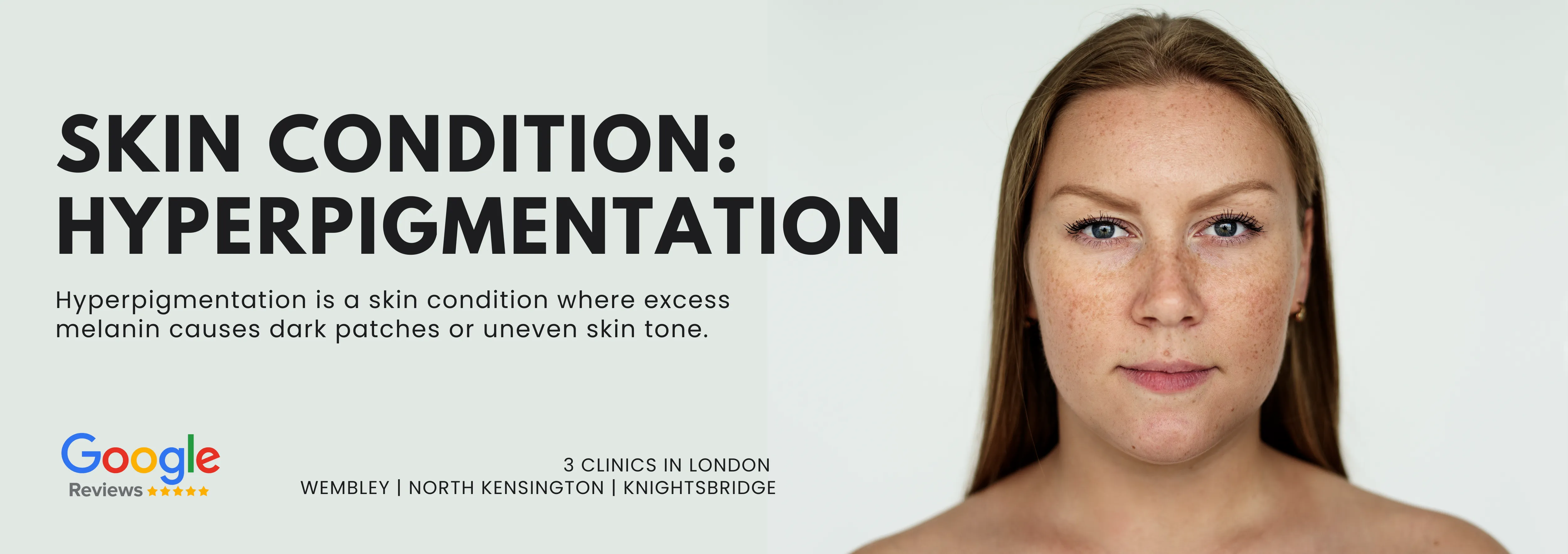 hyperpigmentation