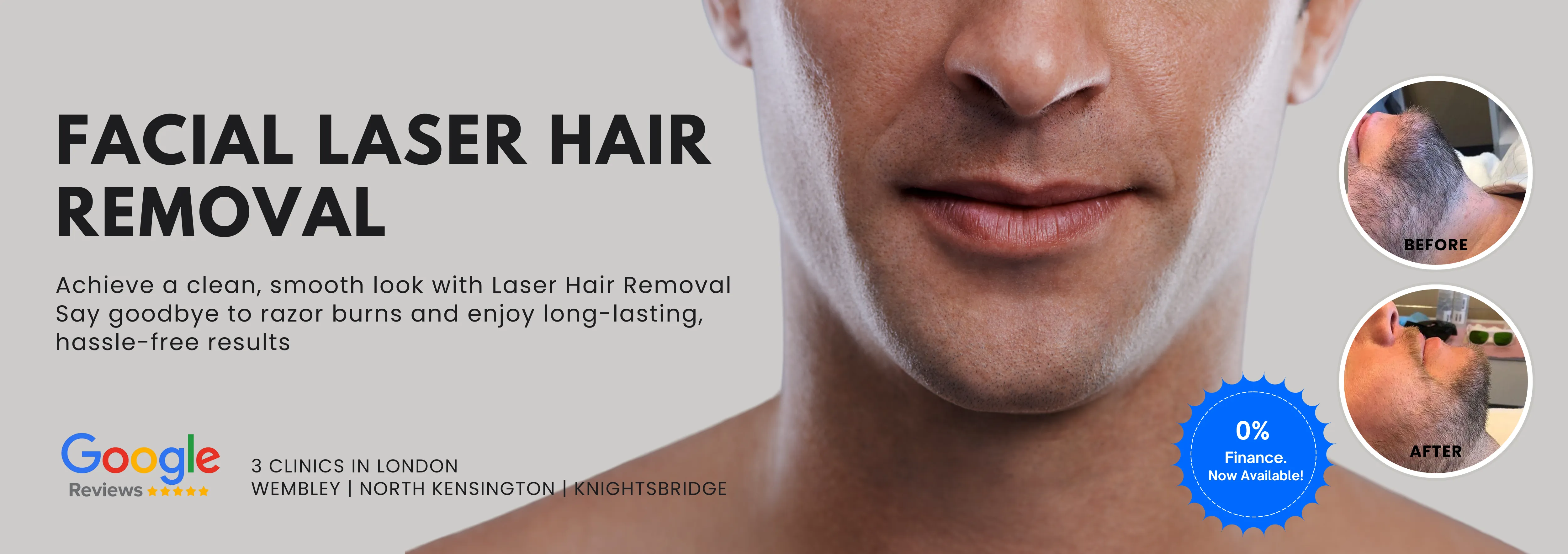 Laser Hair Removal for Men’s Facial Hair
