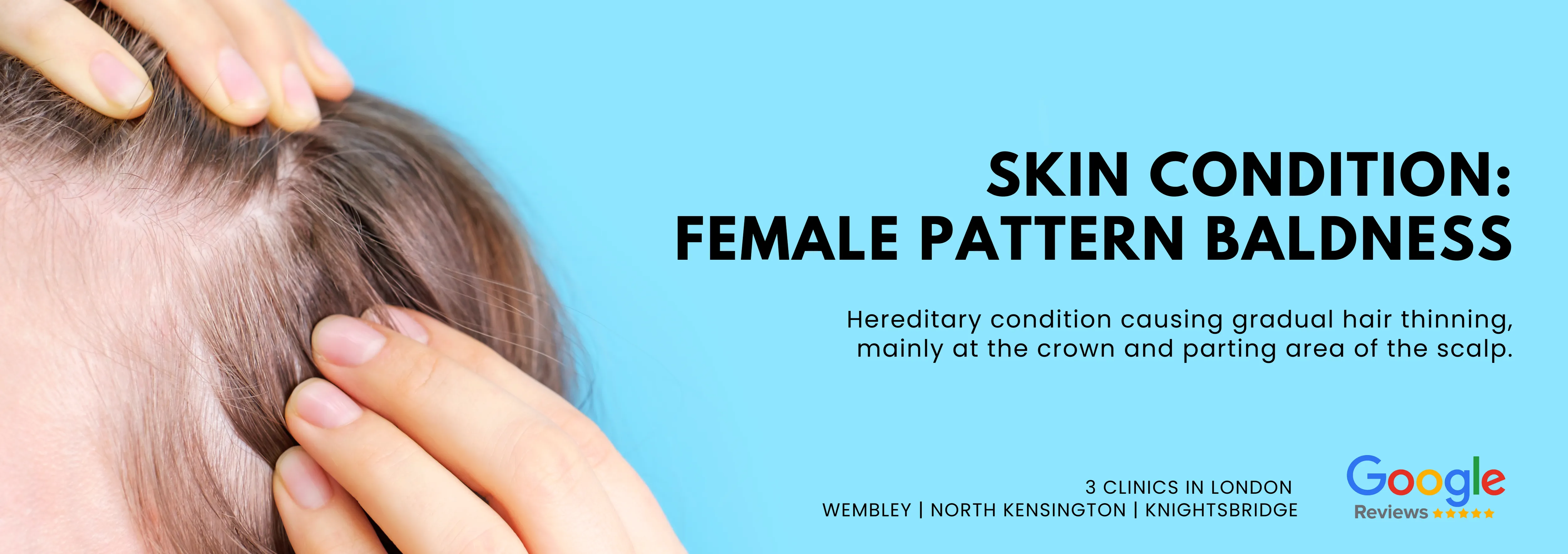 Female Pattern Baldness