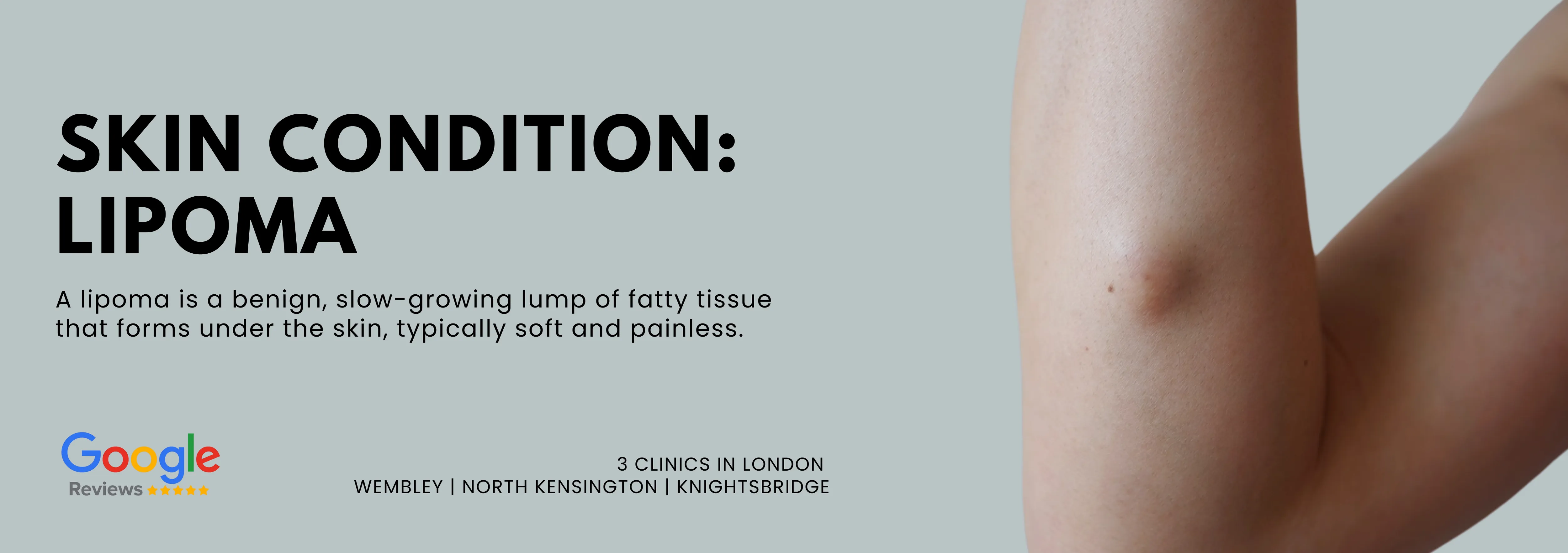Lipoma