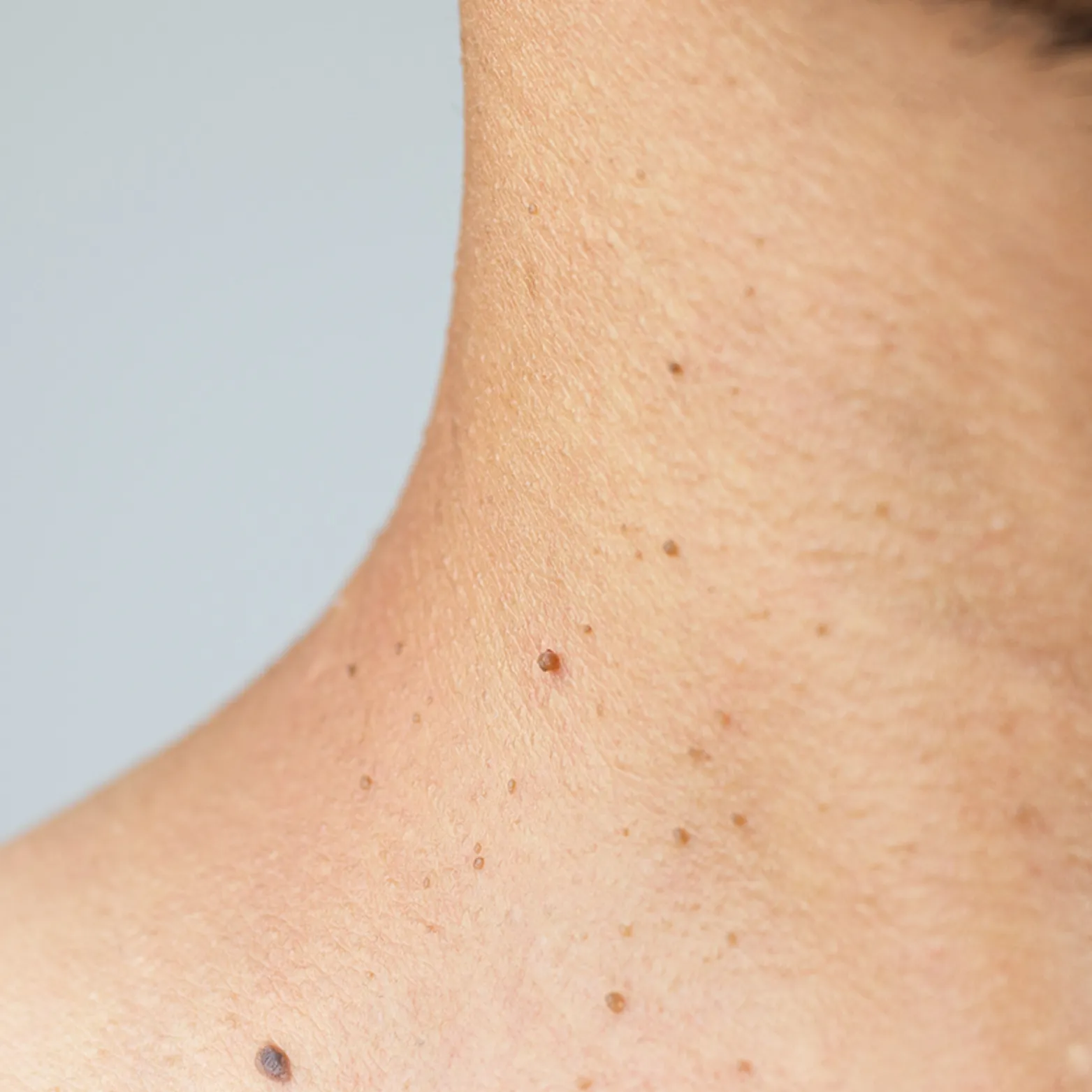 Skin Tag Removal