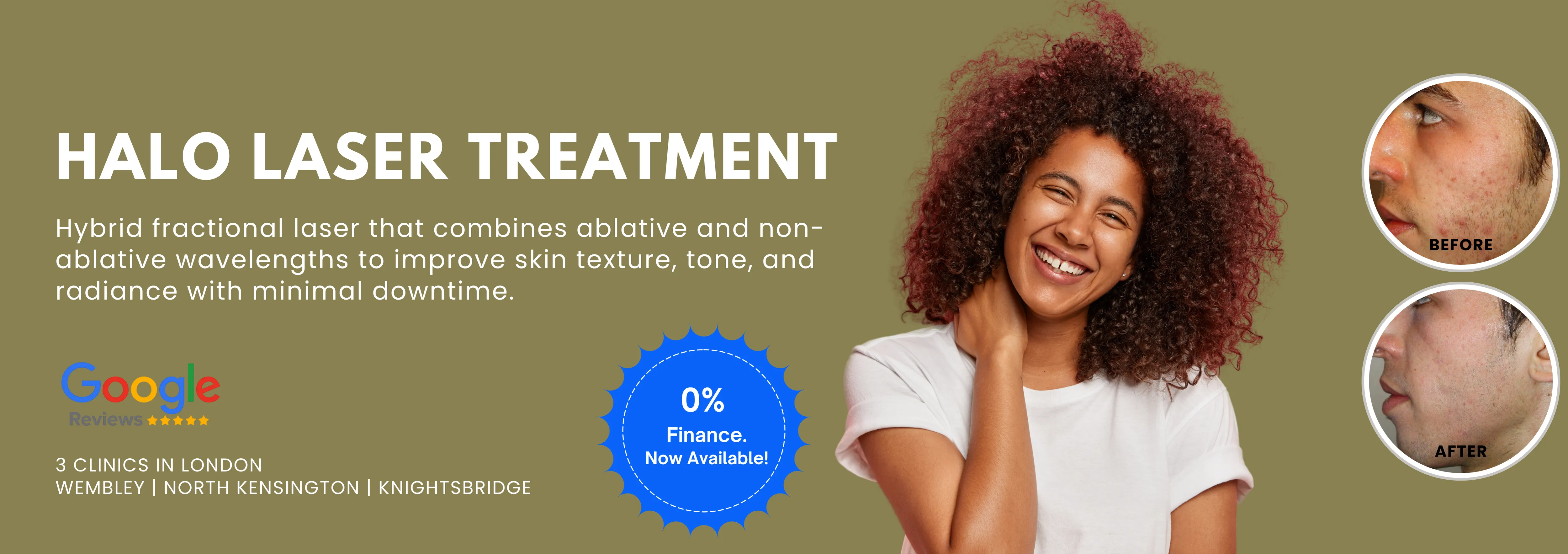 Halo Laser Treatment Sale